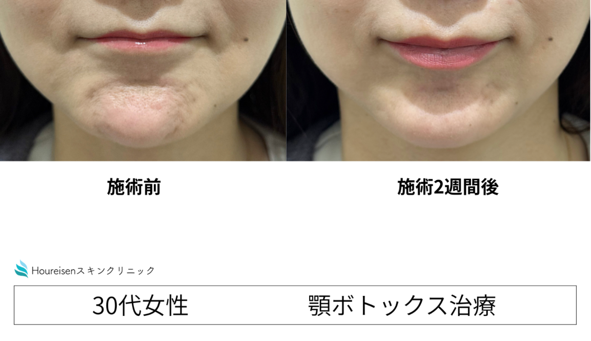 顎の梅干しジワはボトックスで改善できる？効果と症例を解説　②の症例写真