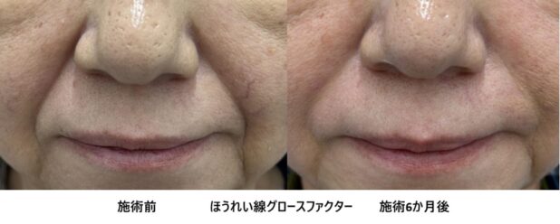60代女性 症例13のほうれい線治療写真