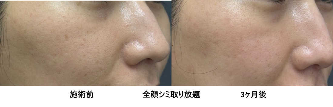レーザーで全顔のシミ・そばかすを除去した症例⑨