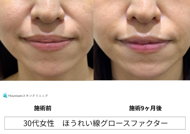 30代女性 症例40のほうれい線治療写真