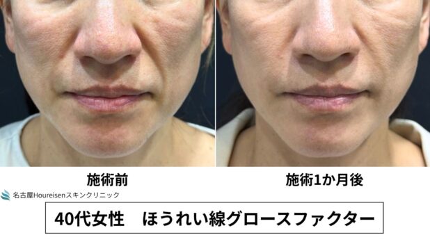 40代女性 症例65のほうれい線治療写真