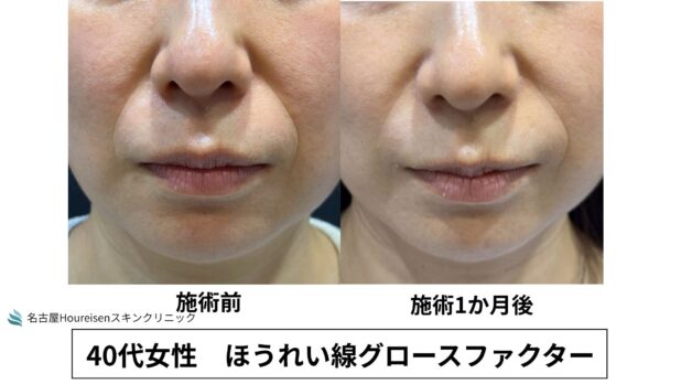 40代女性 症例66のほうれい線治療写真