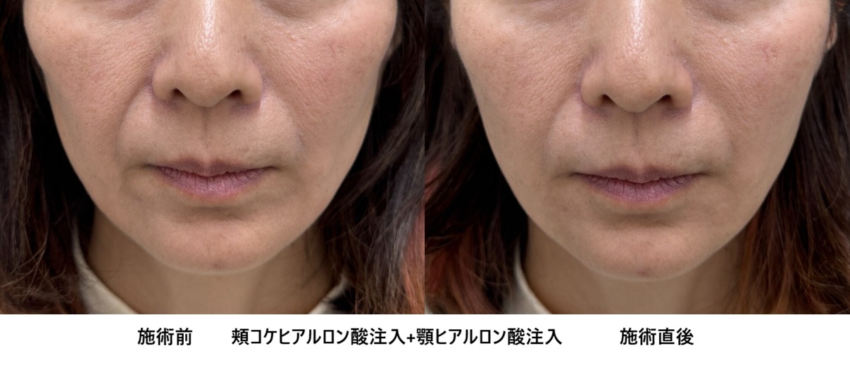 ヒアルロン酸による頬のコケ・窪み（凹み）治療⑩の症例写真