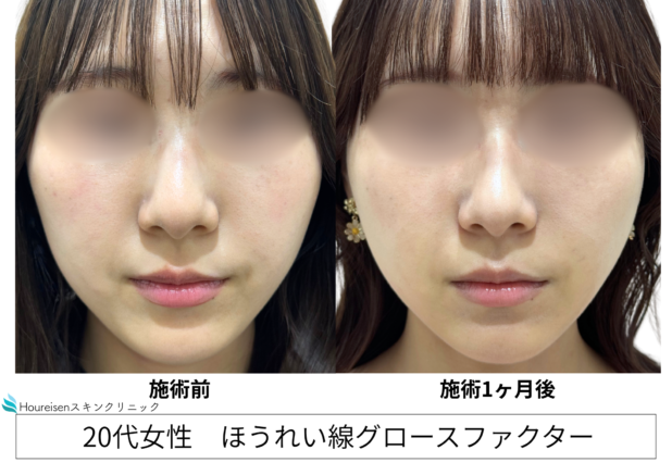 20代女性 症例22のほうれい線治療写真
