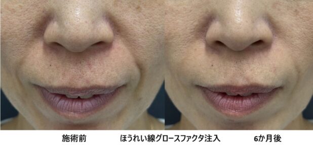 50代女性 症例48のほうれい線治療写真