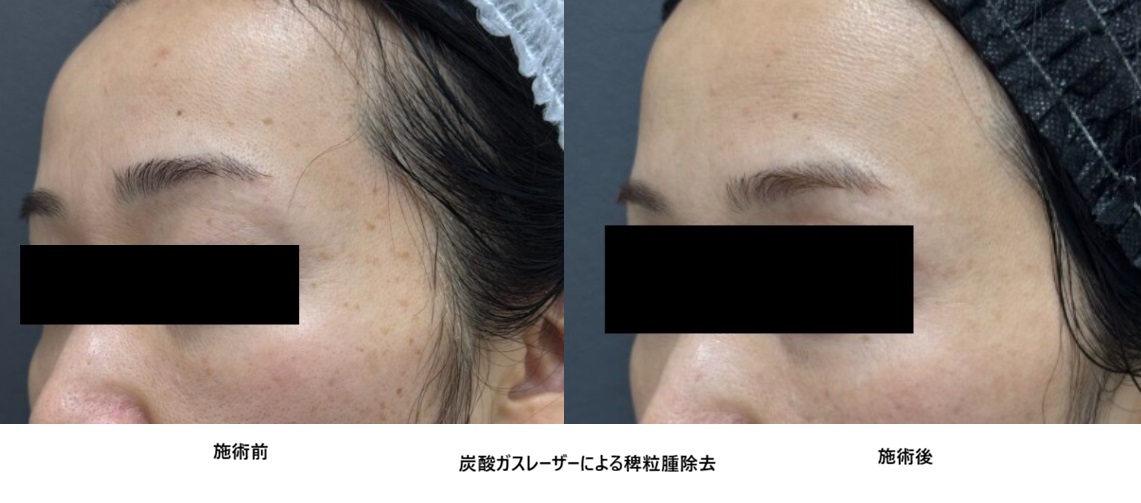 Co2炭酸ガスレーザー稗粒腫(イボ取り)50代　女性④の症例写真