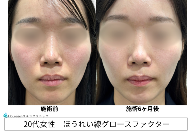 20代女性 症例19のほうれい線治療写真