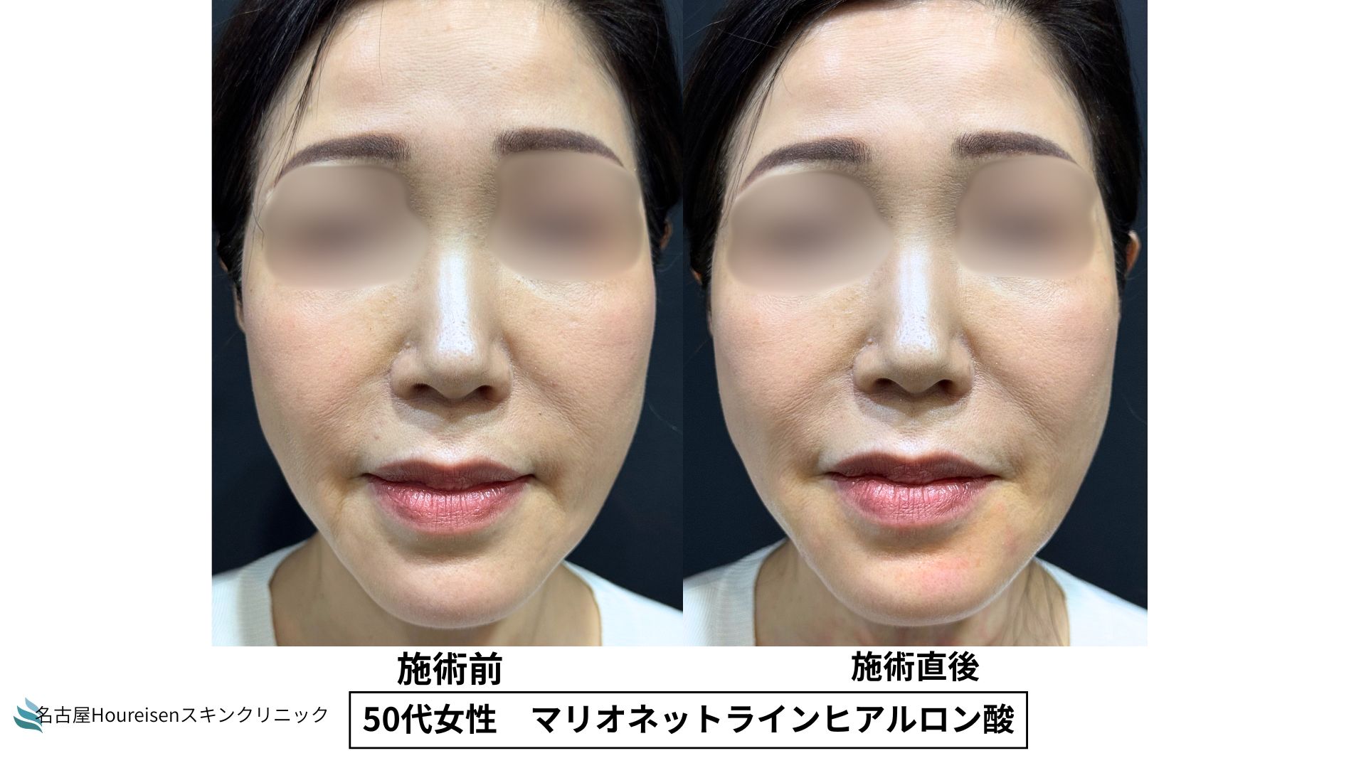 【名古屋】50代女性　マリオネットラインのヒアルロン酸治療　【10】の症例写真
