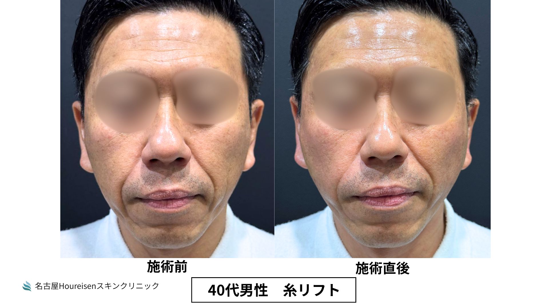 【名古屋】40代男性　糸リフトで口横のもたつき・フェイスラインを改善した症例｜名古屋で糸リフトをご検討の方へ【42】の症例写真