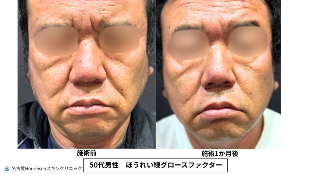 50代男性のほうれい線グロースファクター治療前と治療1か月後の正面比較