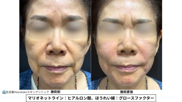 60代女性 症例14のほうれい線治療写真