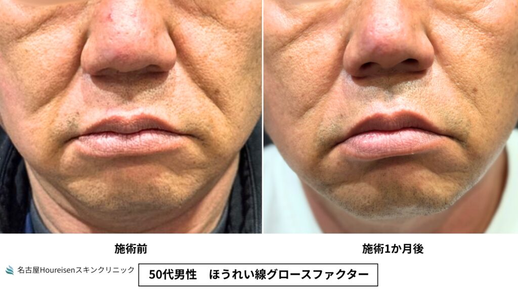 50代男性のほうれい線グロースファクター治療前と治療1か月後の正面口元比較
