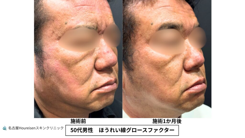 50代男性のほうれい線グロースファクター治療前と治療1か月後の斜め方向比較