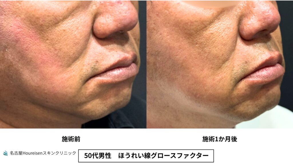 50代男性のほうれい線グロースファクター治療前と治療1か月後の斜め方向口元比較