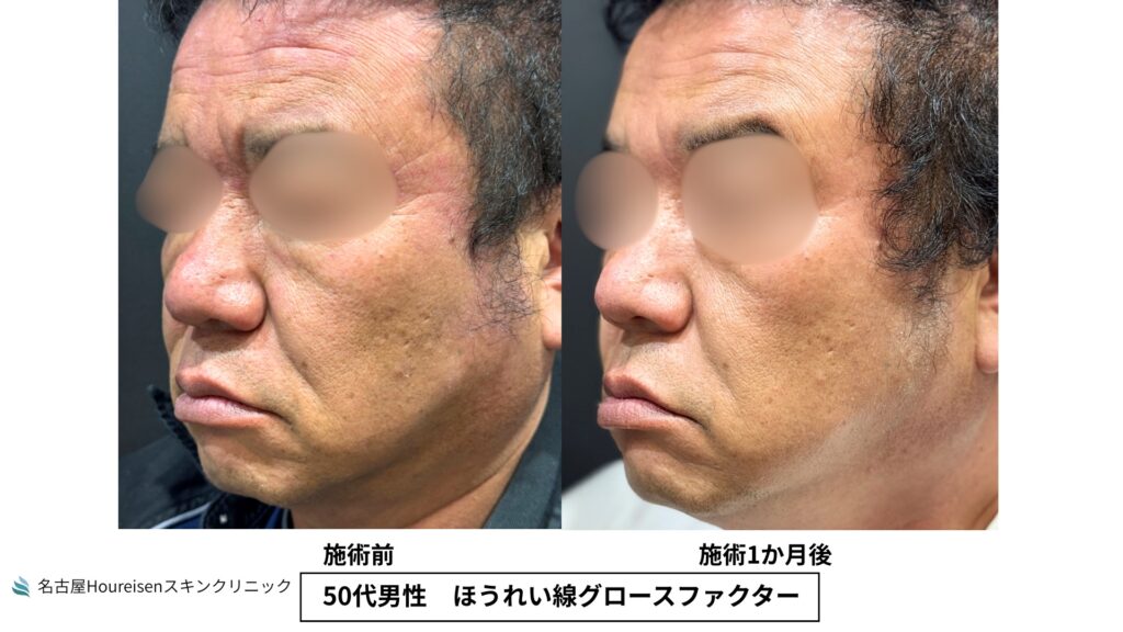 50代男性のほうれい線グロースファクター治療前と治療1か月後の反対側斜め方向比較