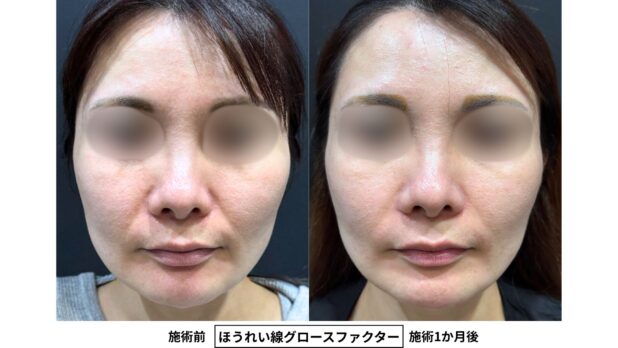 40代女性 症例63のほうれい線治療写真