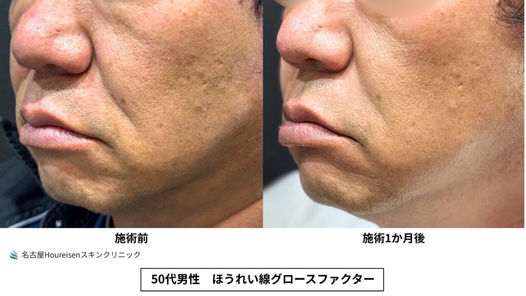 50代男性のほうれい線グロースファクター治療前と治療1か月後の反対側斜め方向口元比較