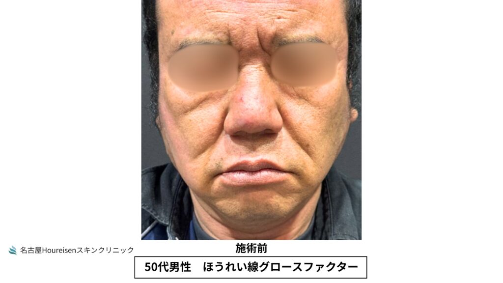 50代男性のほうれい線グロースファクター治療前の正面写真