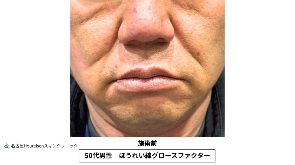 50代男性のほうれい線グロースファクター治療前の正面口元拡大写真