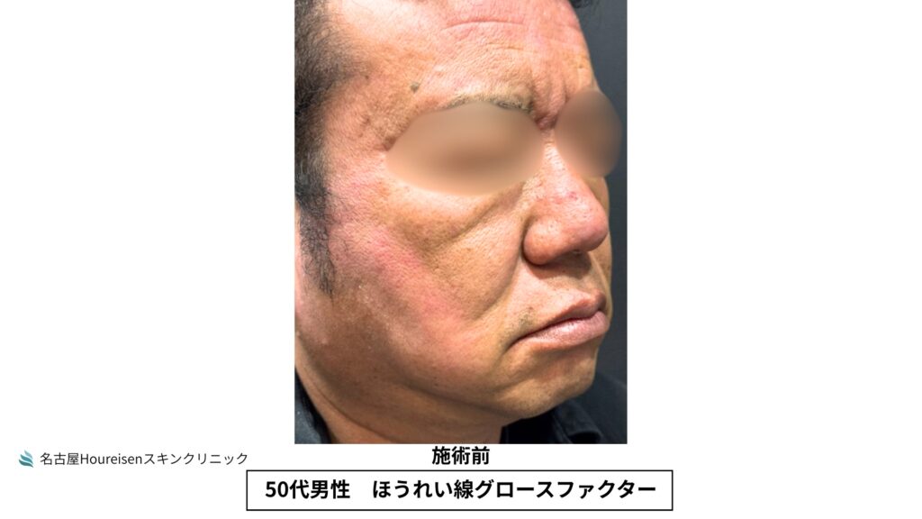 50代男性のほうれい線グロースファクター治療前の斜め方向写真
