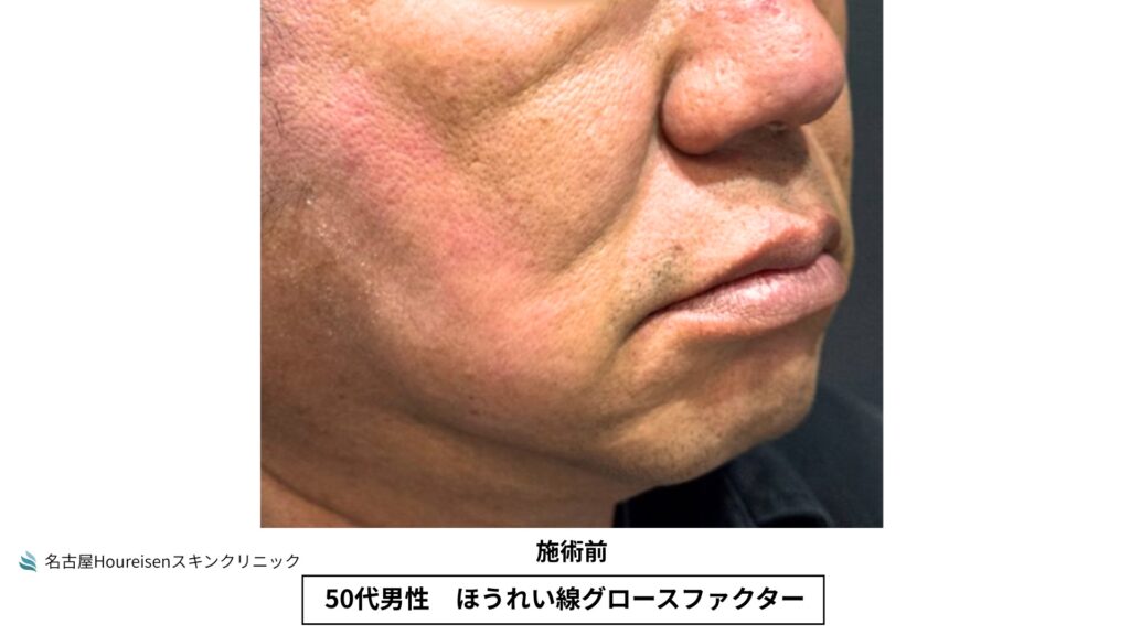 50代男性のほうれい線グロースファクター治療前の斜め方向口元拡大写真