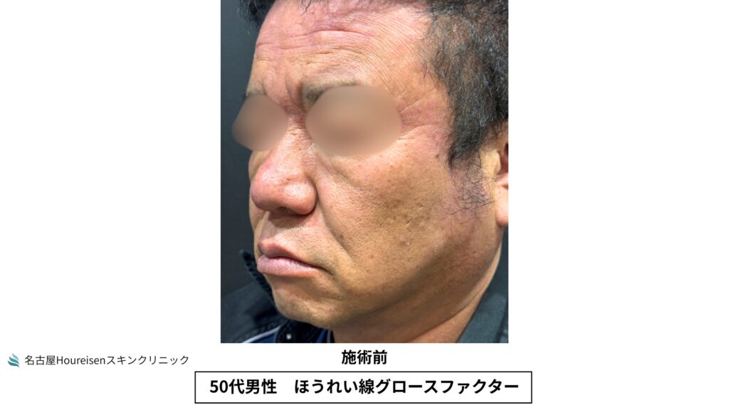 50代男性のほうれい線グロースファクター治療前の反対側斜め方向写真