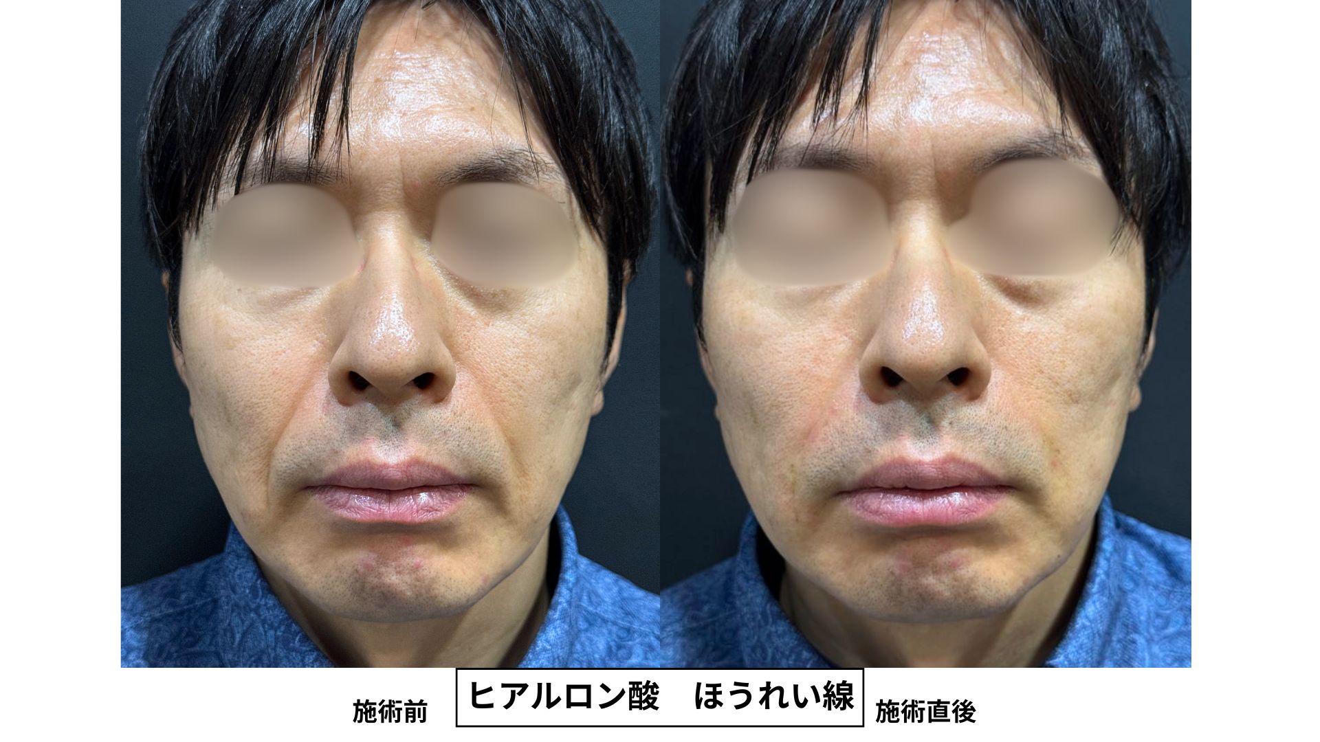 【名古屋】40代男性 しつこく残る口横のほうれい線をヒアルロン酸1本で改善した症例㊼の症例写真