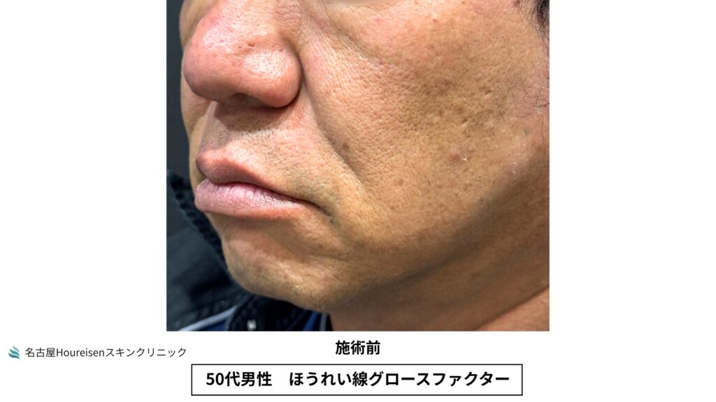 50代男性のほうれい線グロースファクター治療前の反対側口元拡大写真