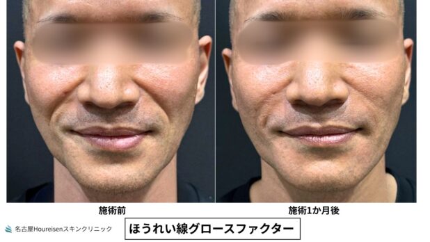 40代男性 症例1のほうれい線治療写真