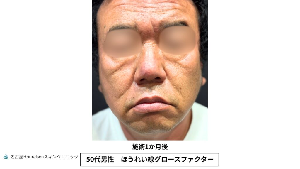 50代男性のほうれい線グロースファクター治療1か月後の正面写真