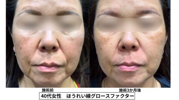 50代女性 症例44のほうれい線治療写真