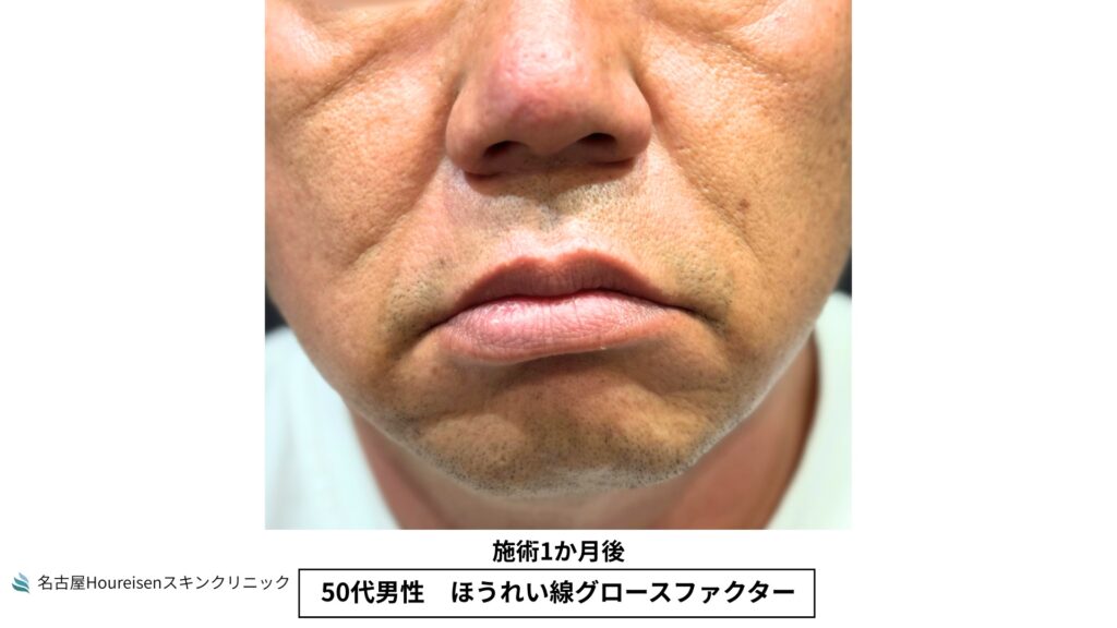 50代男性のほうれい線グロースファクター治療1か月後の正面口元拡大写真