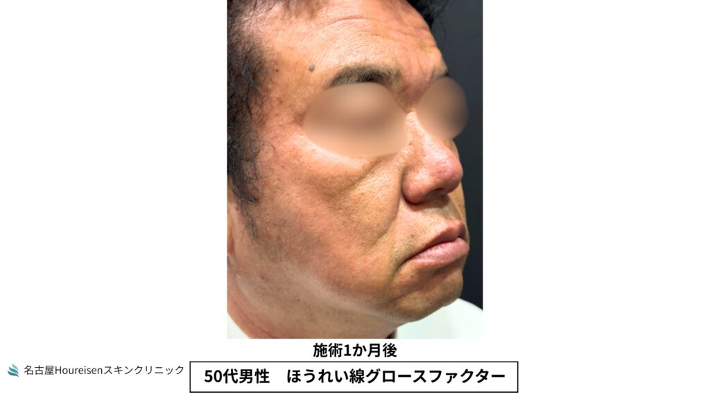 50代男性のほうれい線グロースファクター治療1か月後の斜め方向写真