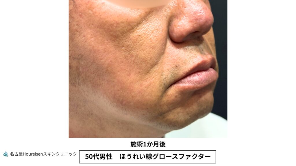 50代男性のほうれい線グロースファクター治療1か月後の斜め方向口元拡大写真