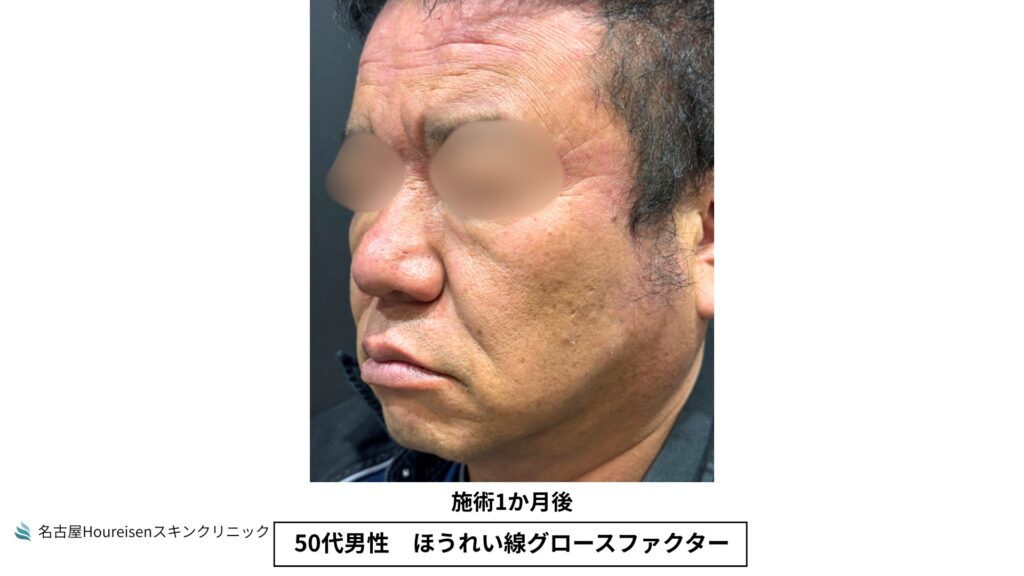 50代男性のほうれい線グロースファクター治療1か月後の反対側斜め方向写真