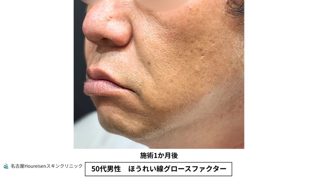 50代男性のほうれい線グロースファクター治療1か月後の反対側口元拡大写真