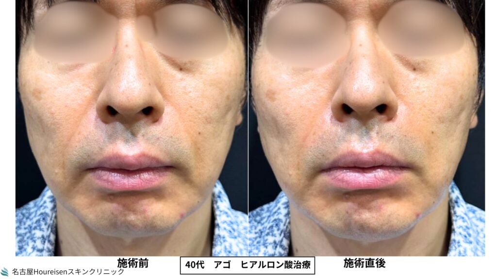 40代男性の顎ヒアルロン酸治療 施術前と施術直後の比較 VIEW 01