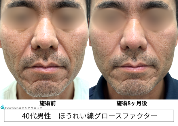 40代男性 症例12のほうれい線治療写真