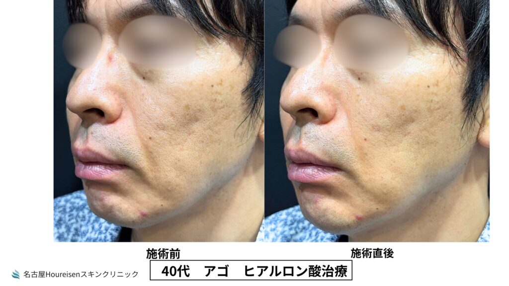 40代男性の顎ヒアルロン酸治療 施術前と施術直後の比較 VIEW 03