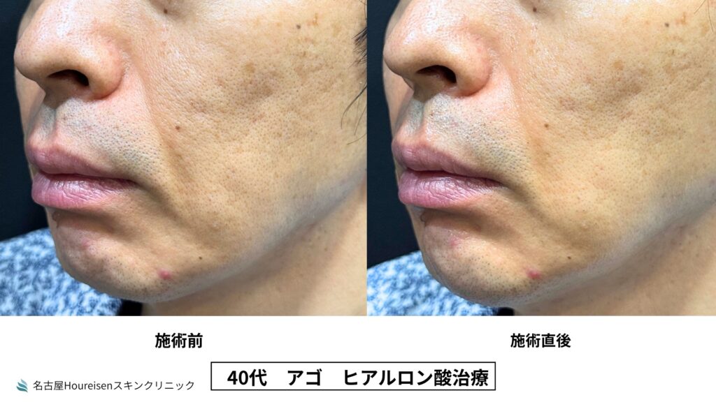 40代男性の顎ヒアルロン酸治療 施術前と施術直後の比較 VIEW 04