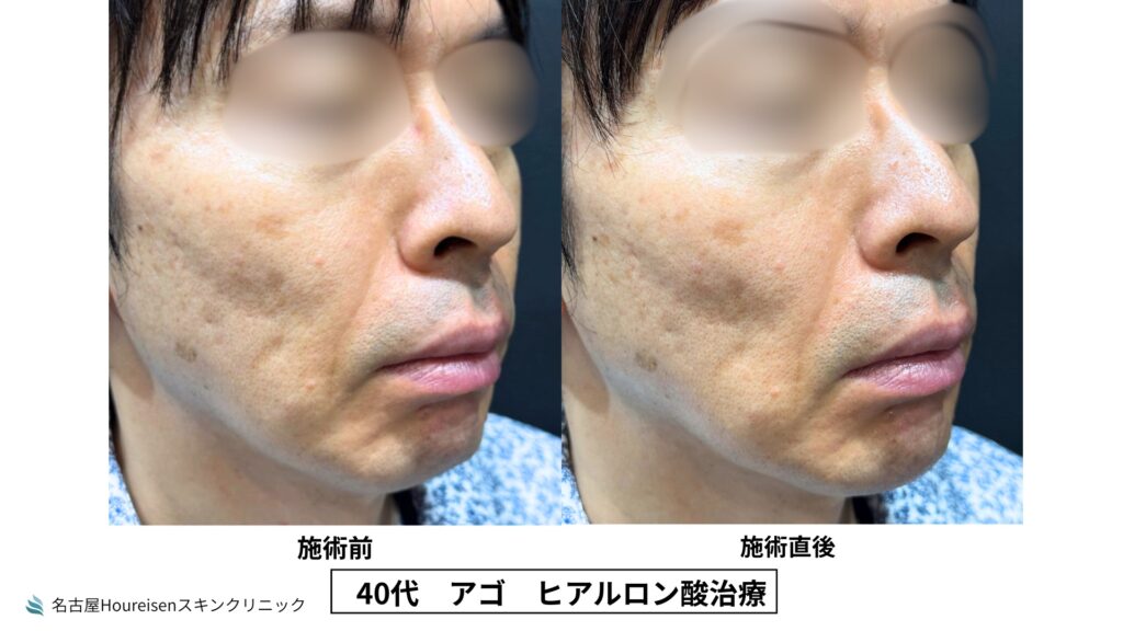 40代男性の顎ヒアルロン酸治療 施術前と施術直後の比較 VIEW 05