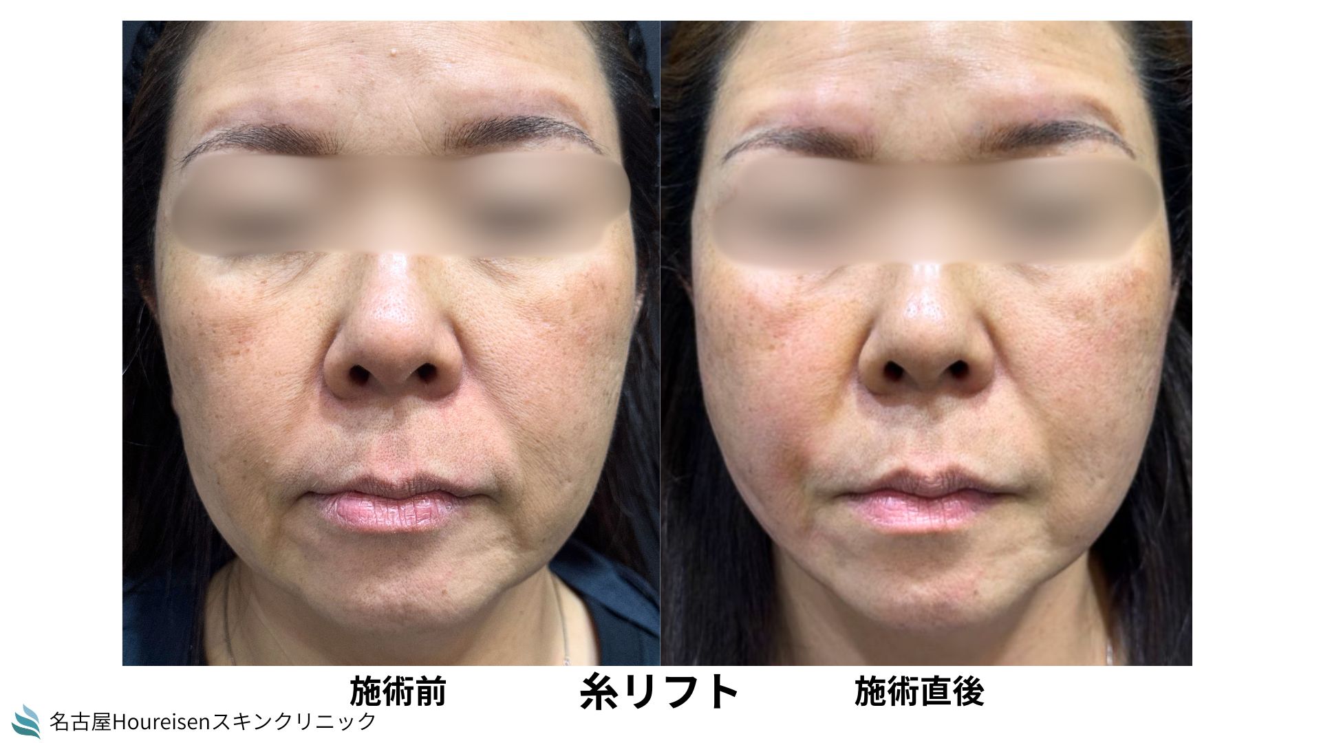 【名古屋】50代女性　頬のたるみとフェイスラインの改善のため糸リフトをした症例【㊶】の症例写真