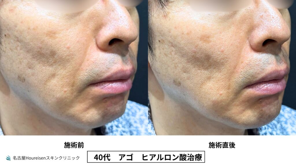 40代男性の顎ヒアルロン酸治療 施術前と施術直後の比較 VIEW 06