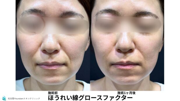 30代女性 症例64のほうれい線治療写真