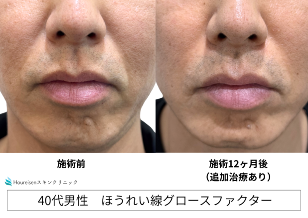 40代男性 症例14のほうれい線治療写真