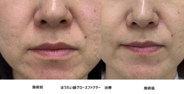 40代女性 症例68のほうれい線治療写真