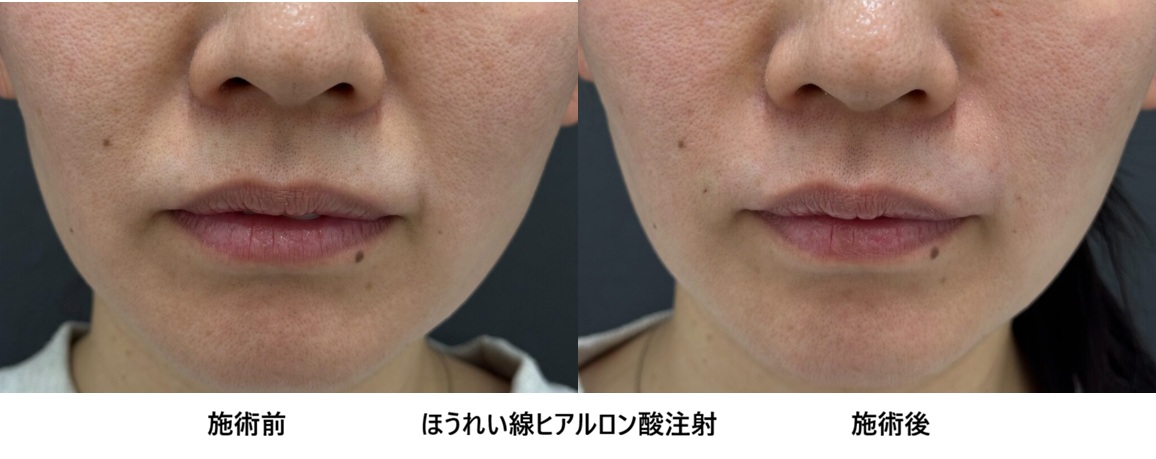 ヒアルロン酸注射で気になるほうれい線改善 40代女性症例㊹の症例写真
