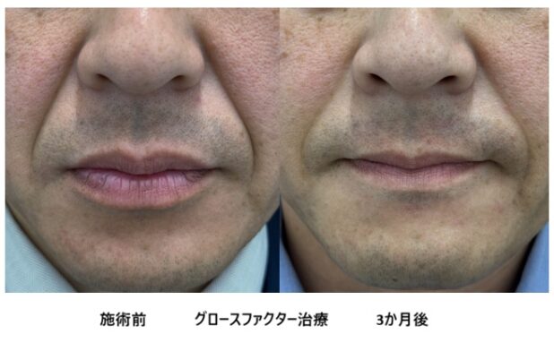 40代男性 症例13のほうれい線治療写真