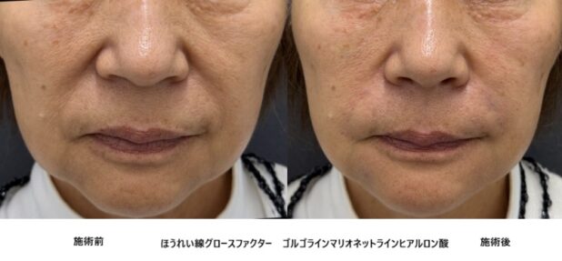 60代女性 症例16のほうれい線治療写真