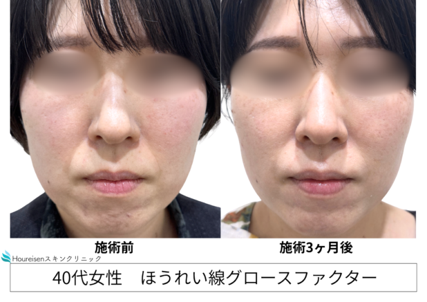 40代女性 症例59のほうれい線治療写真